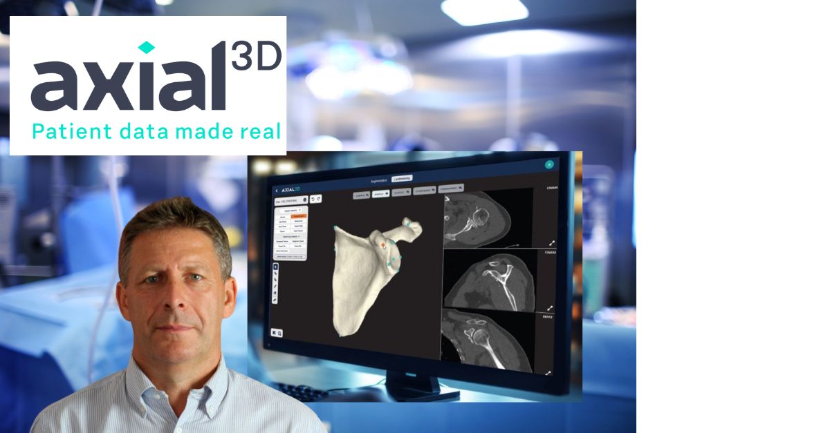 LinkedIn post preview for Axial3D